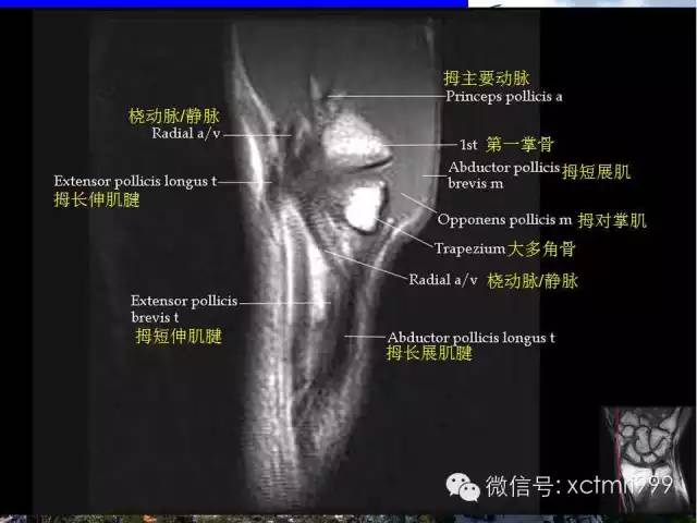 影像PPT - 【PPT】腕关节MRI解剖中英对照-29