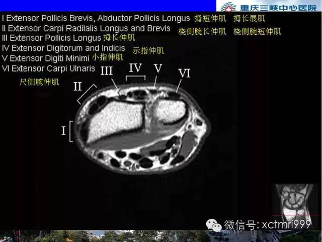 影像PPT - 【PPT】腕关节MRI解剖中英对照-31