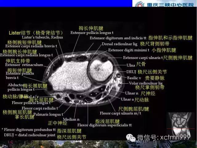 影像PPT - 【PPT】腕关节MRI解剖中英对照-35