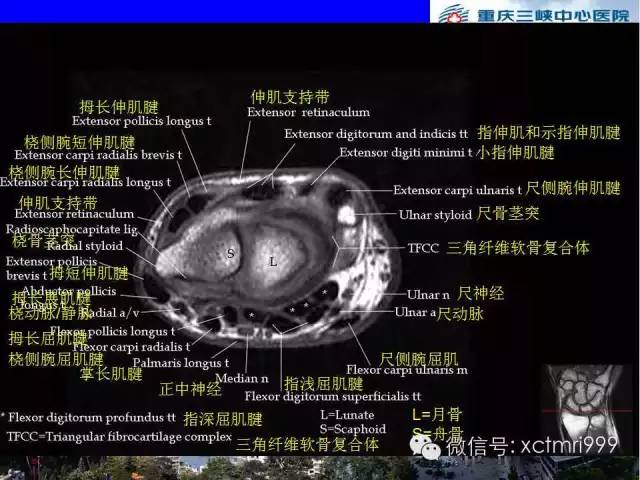 影像PPT - 【PPT】腕关节MRI解剖中英对照-37