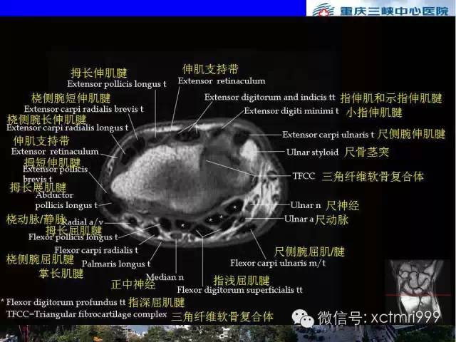 影像PPT - 【PPT】腕关节MRI解剖中英对照-36