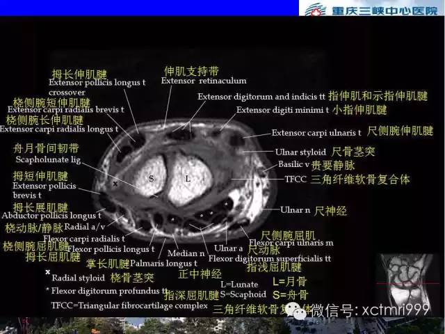 影像PPT - 【PPT】腕关节MRI解剖中英对照-38