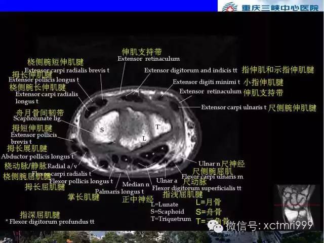 影像PPT - 【PPT】腕关节MRI解剖中英对照-39
