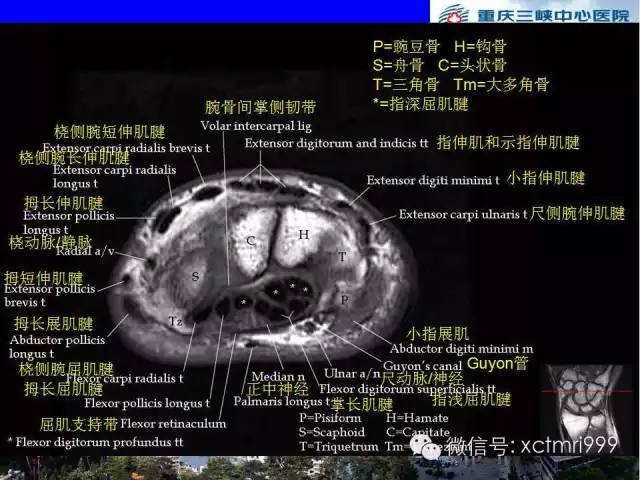 影像PPT - 【PPT】腕关节MRI解剖中英对照-43