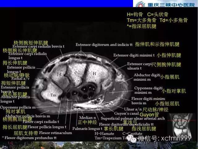 影像PPT - 【PPT】腕关节MRI解剖中英对照-44