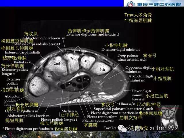 影像PPT - 【PPT】腕关节MRI解剖中英对照-47