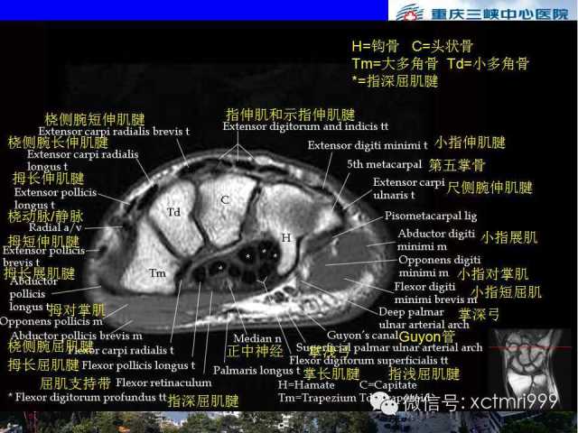 影像PPT - 【PPT】腕关节MRI解剖中英对照-45