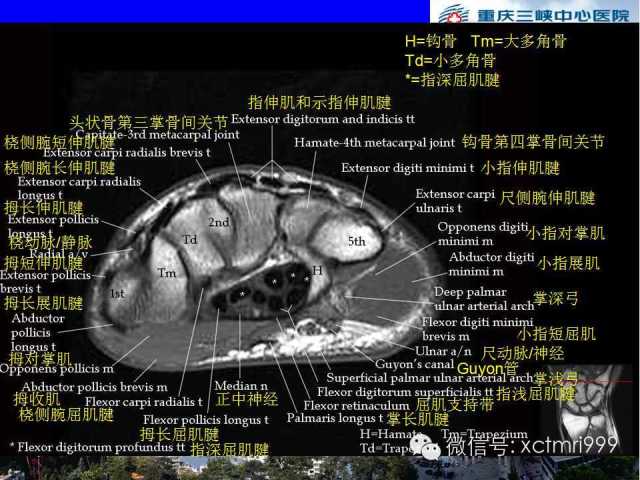 影像PPT - 【PPT】腕关节MRI解剖中英对照-46