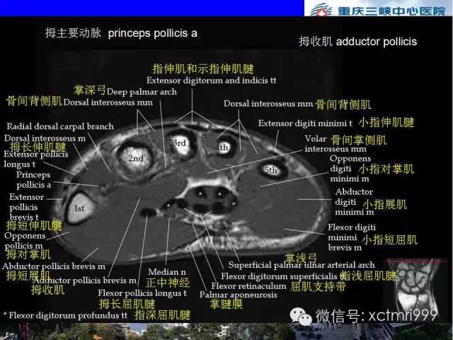 影像PPT - 【PPT】腕关节MRI解剖中英对照-50