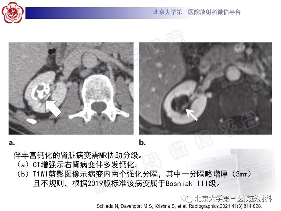 影像PPT - 【PPT】肾脏囊性病变BOSNIAK分级标准(2019版)解读-14