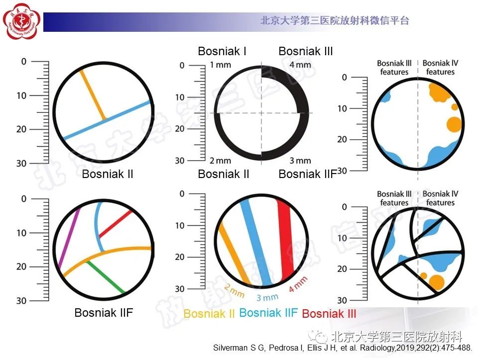 影像PPT - 【PPT】肾脏囊性病变BOSNIAK分级标准(2019版)解读-23