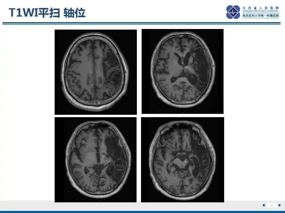 影像PPT - 【PPT】华勒氏变性-3