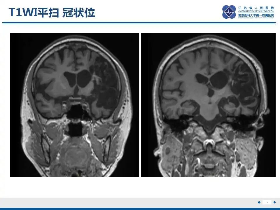 影像PPT - 【PPT】华勒氏变性-4