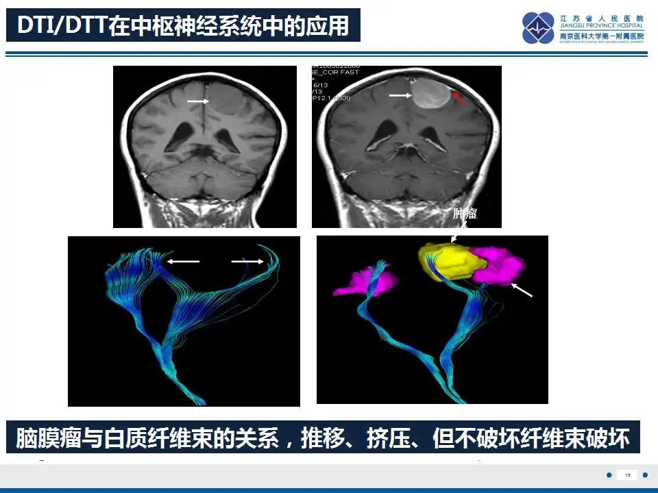 影像PPT - 【PPT】华勒氏变性-16