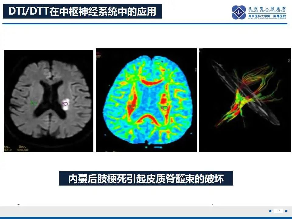 影像PPT - 【PPT】华勒氏变性-18