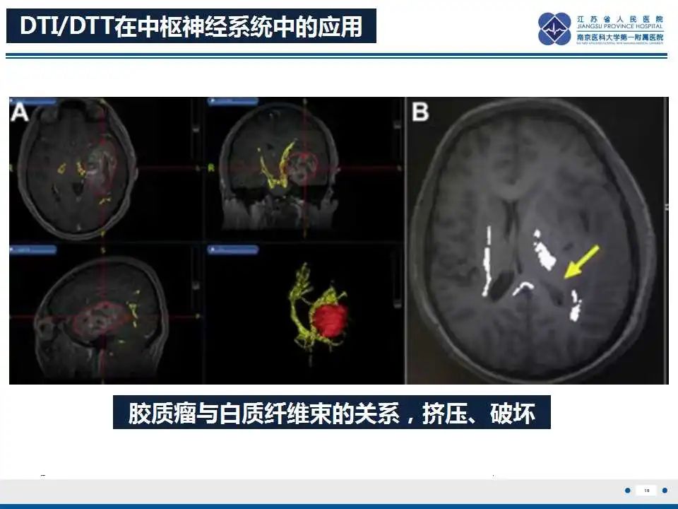 影像PPT - 【PPT】华勒氏变性-17