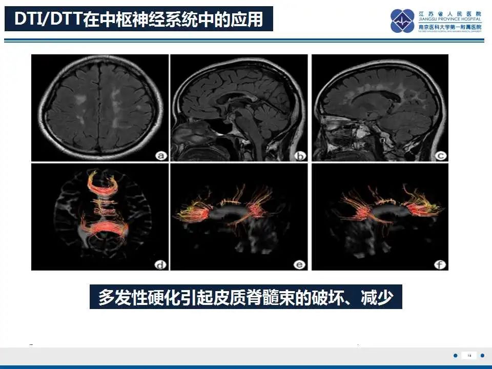 影像PPT - 【PPT】华勒氏变性-19