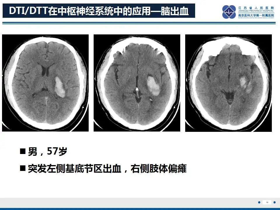 影像PPT - 【PPT】华勒氏变性-20