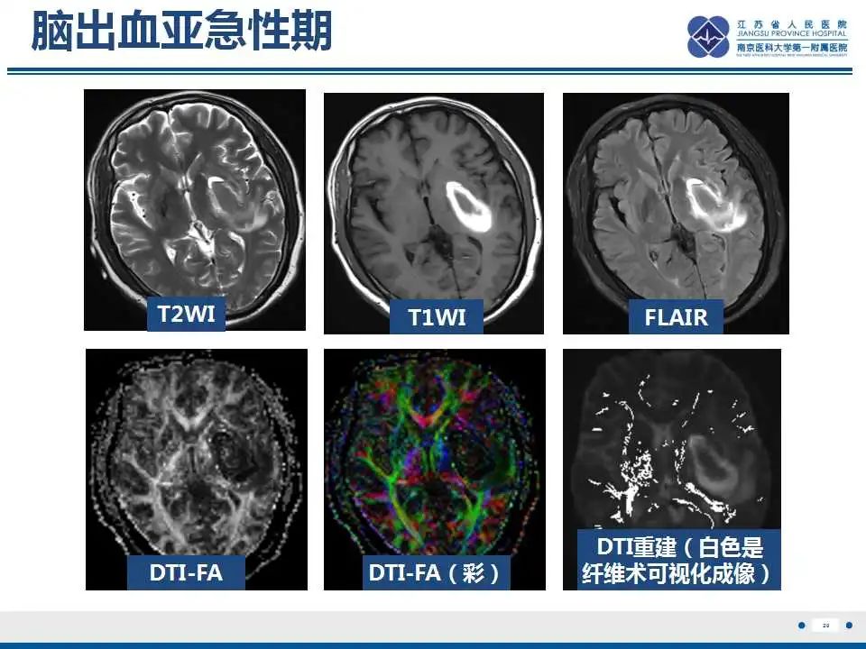 影像PPT - 【PPT】华勒氏变性-21