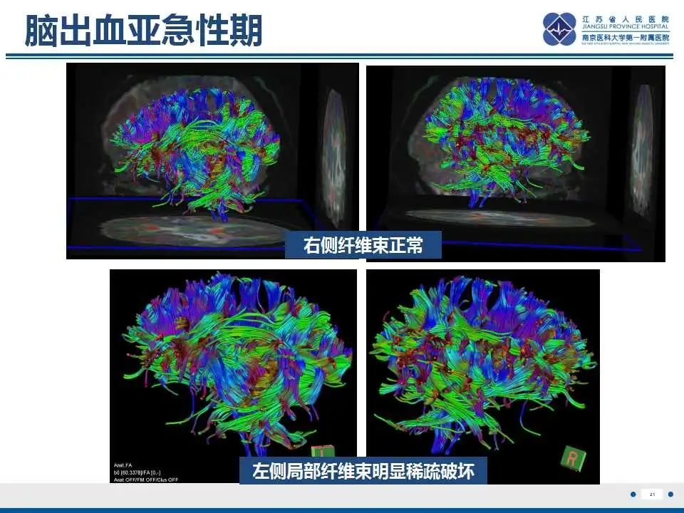 影像PPT - 【PPT】华勒氏变性-22