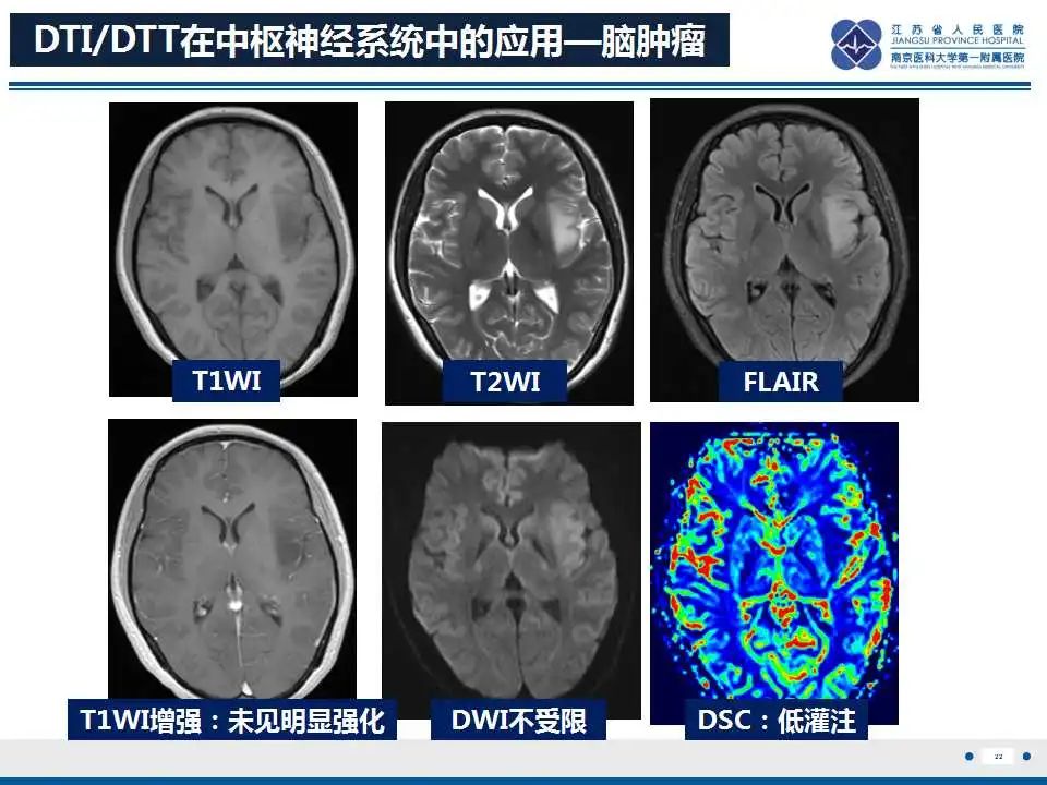 影像PPT - 【PPT】华勒氏变性-23