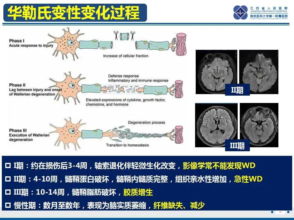 影像PPT - 【PPT】华勒氏变性-32