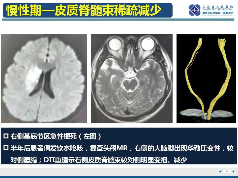 影像PPT - 【PPT】华勒氏变性-34