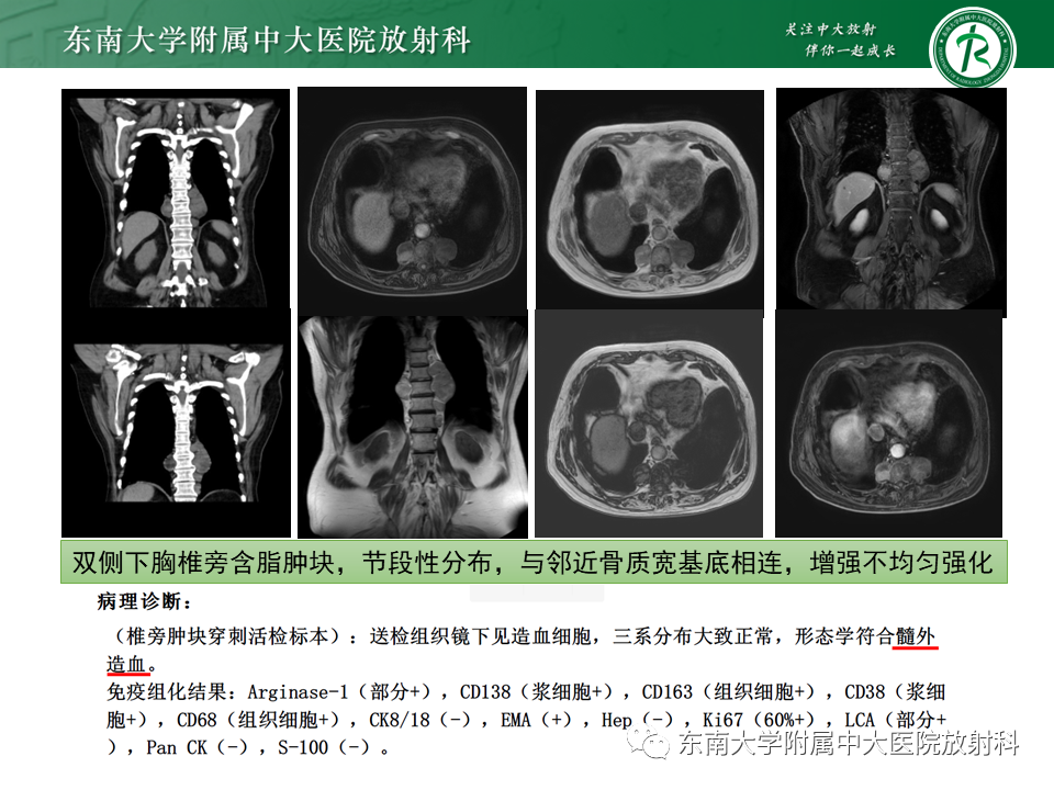 影像PPT - 【PPT】胸内髓外造血的影像表现-3 影像PPT - 【PPT】胸内髓外造血的影像表现-3