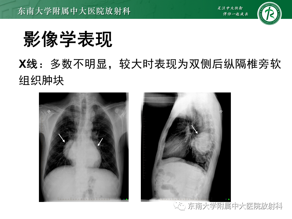影像PPT - 【PPT】胸内髓外造血的影像表现-11 影像PPT - 【PPT】胸内髓外造血的影像表现-11