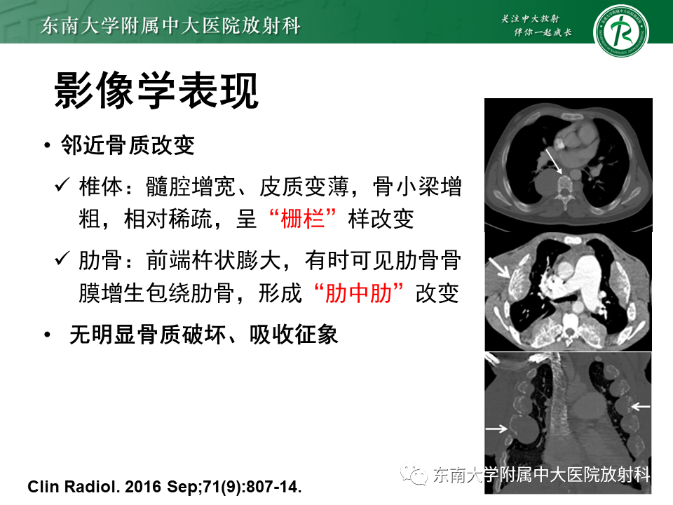 影像PPT - 【PPT】胸内髓外造血的影像表现-13 影像PPT - 【PPT】胸内髓外造血的影像表现-13