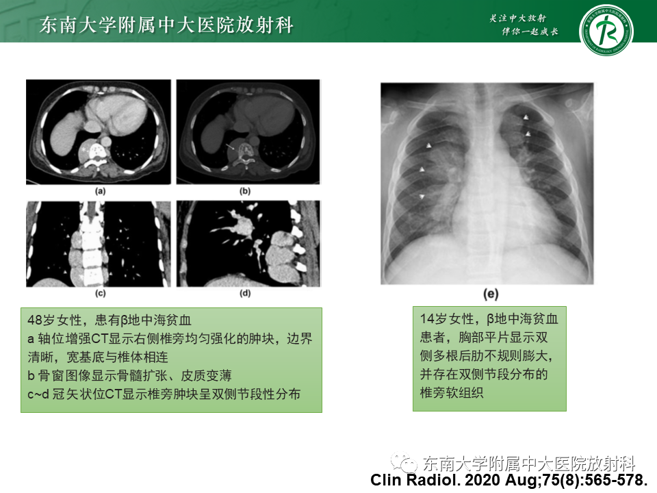 影像PPT - 【PPT】胸内髓外造血的影像表现-15 影像PPT - 【PPT】胸内髓外造血的影像表现-15