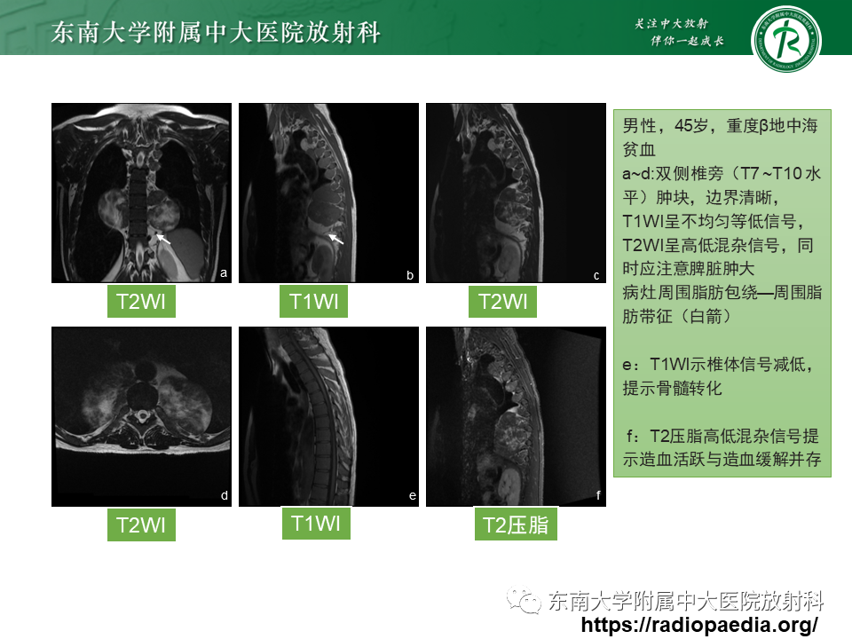 影像PPT - 【PPT】胸内髓外造血的影像表现-16 影像PPT - 【PPT】胸内髓外造血的影像表现-16