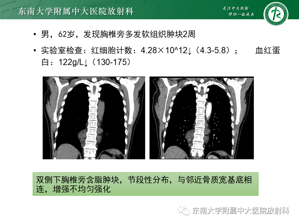 影像PPT - 【PPT】胸内髓外造血的影像表现-17 影像PPT - 【PPT】胸内髓外造血的影像表现-17