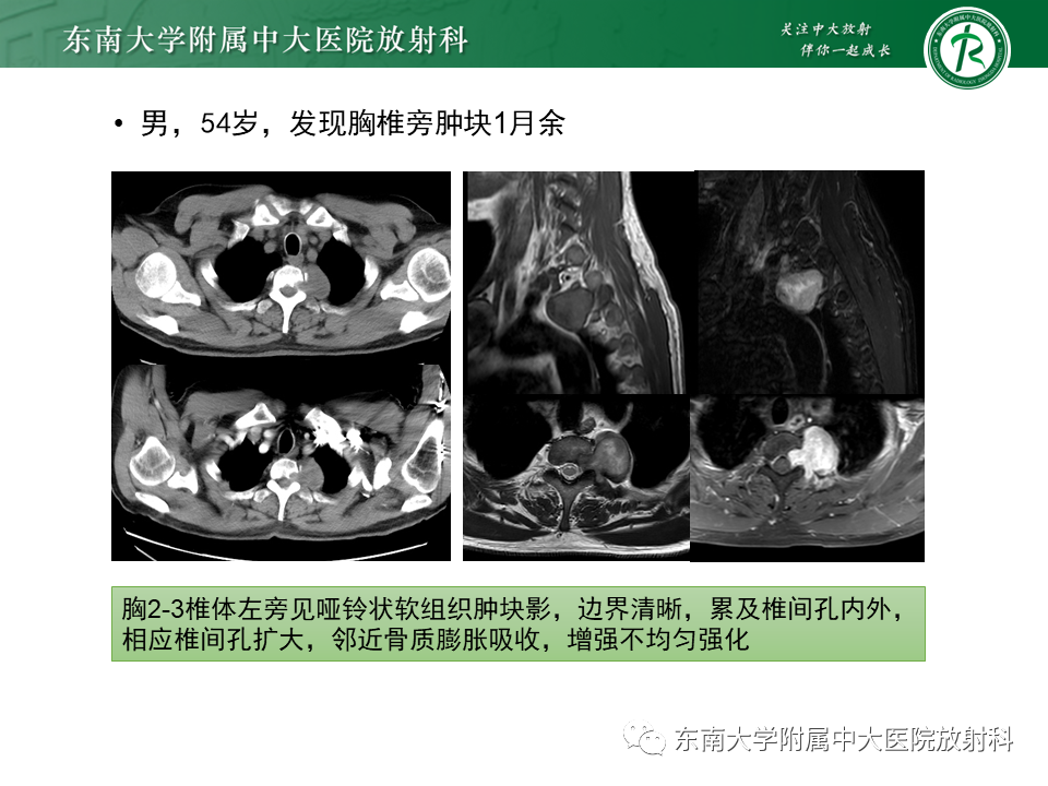 影像PPT - 【PPT】胸内髓外造血的影像表现-22 影像PPT - 【PPT】胸内髓外造血的影像表现-22