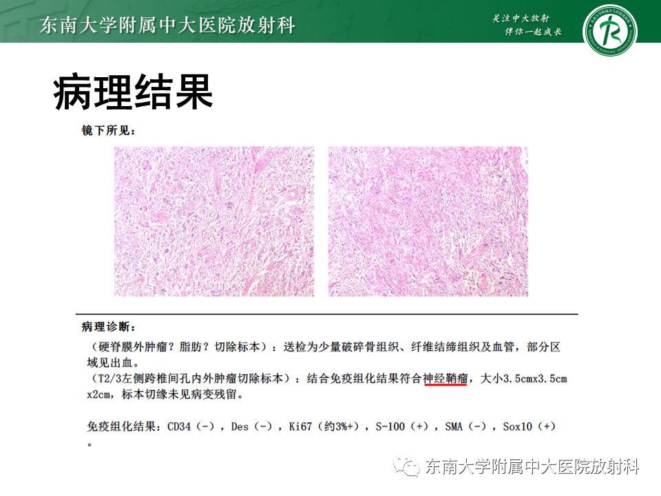 影像PPT - 【PPT】胸内髓外造血的影像表现-23 影像PPT - 【PPT】胸内髓外造血的影像表现-23
