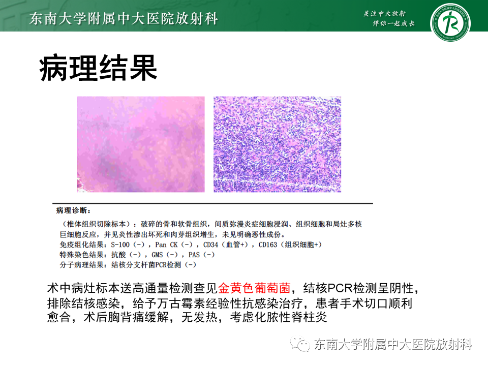 影像PPT - 【PPT】胸内髓外造血的影像表现-30 影像PPT - 【PPT】胸内髓外造血的影像表现-30