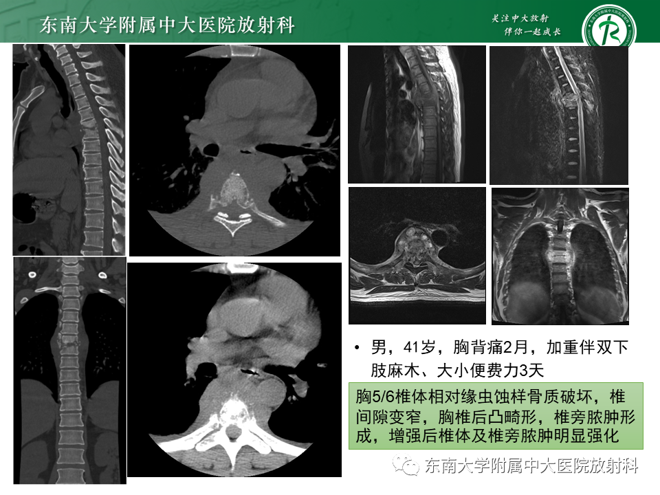 影像PPT - 【PPT】胸内髓外造血的影像表现-29 影像PPT - 【PPT】胸内髓外造血的影像表现-29