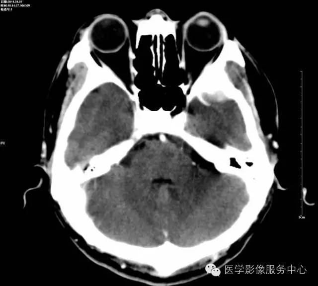 影像PPT - 头颅CT的观察盲区,你都知道吗?-4 影像PPT - 头颅CT的观察盲区,你都知道吗?-4