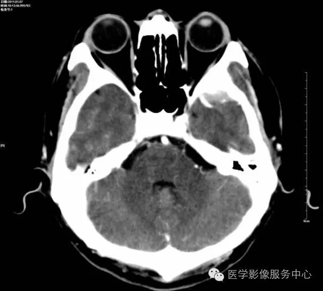 影像PPT - 头颅CT的观察盲区,你都知道吗?-3 影像PPT - 头颅CT的观察盲区,你都知道吗?-3