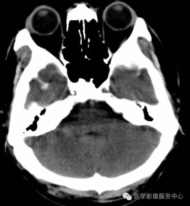 影像PPT - 头颅CT的观察盲区,你都知道吗?-1 影像PPT - 头颅CT的观察盲区,你都知道吗?-1