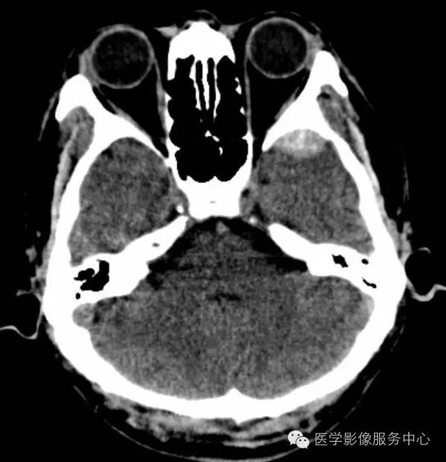 影像PPT - 头颅CT的观察盲区,你都知道吗?-8 影像PPT - 头颅CT的观察盲区,你都知道吗?-8