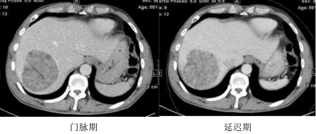 影像PPT - 【病例】含脂肝细胞癌1例CT影像-4 影像PPT - 【病例】含脂肝细胞癌1例CT影像-4
