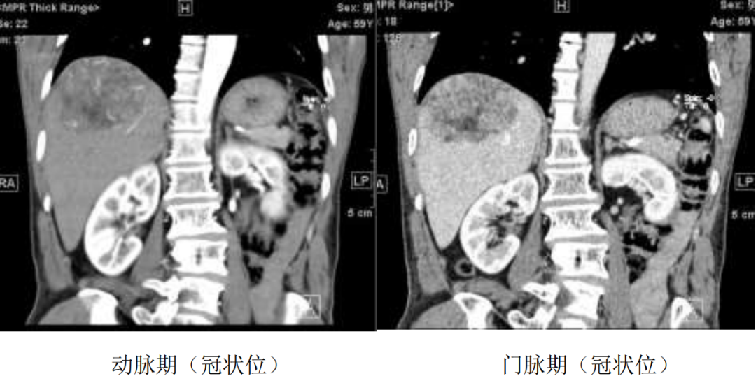 影像PPT - 【病例】含脂肝细胞癌1例CT影像-5 影像PPT - 【病例】含脂肝细胞癌1例CT影像-5