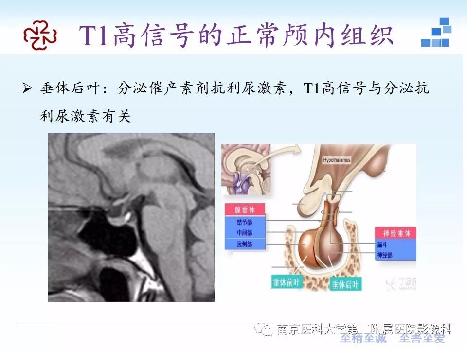 影像PPT - 【PPT】颅内短T1信号的影像诊断-4