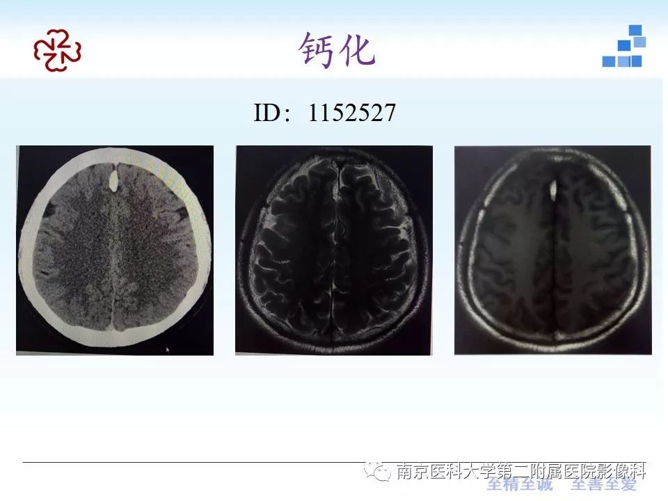 影像PPT - 【PPT】颅内短T1信号的影像诊断-6
