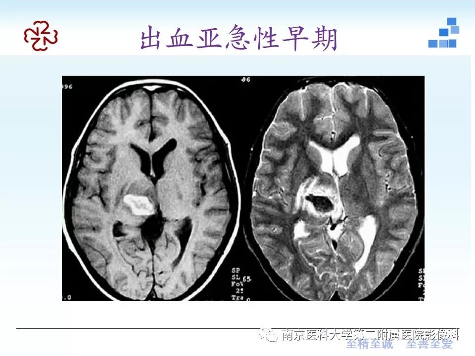 影像PPT - 【PPT】颅内短T1信号的影像诊断-11