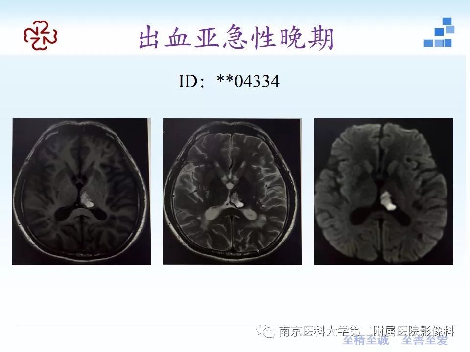 影像PPT - 【PPT】颅内短T1信号的影像诊断-12