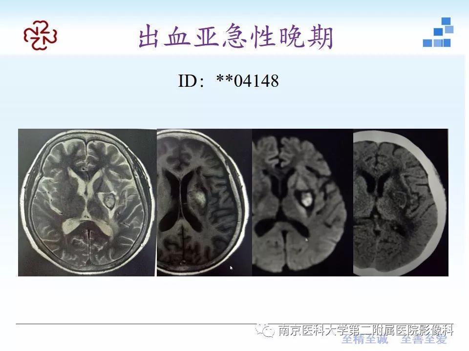影像PPT - 【PPT】颅内短T1信号的影像诊断-13