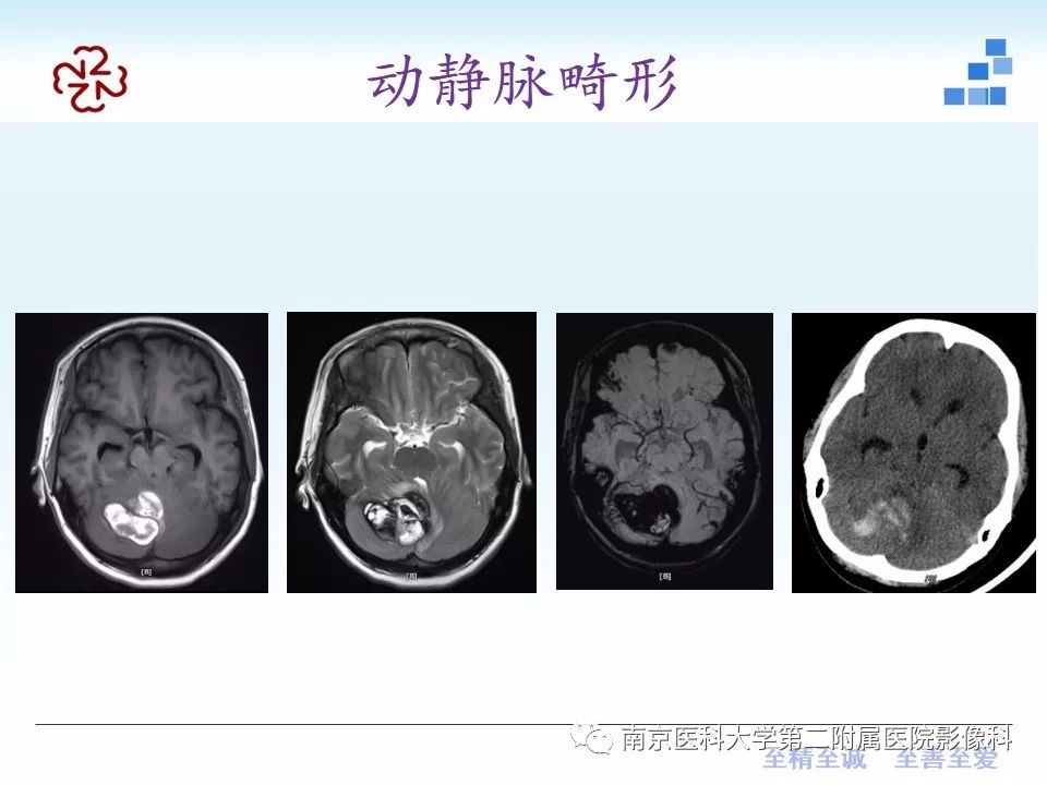 影像PPT - 【PPT】颅内短T1信号的影像诊断-17