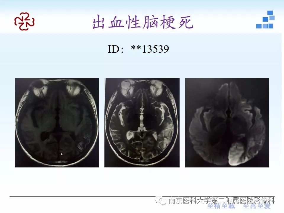 影像PPT - 【PPT】颅内短T1信号的影像诊断-14